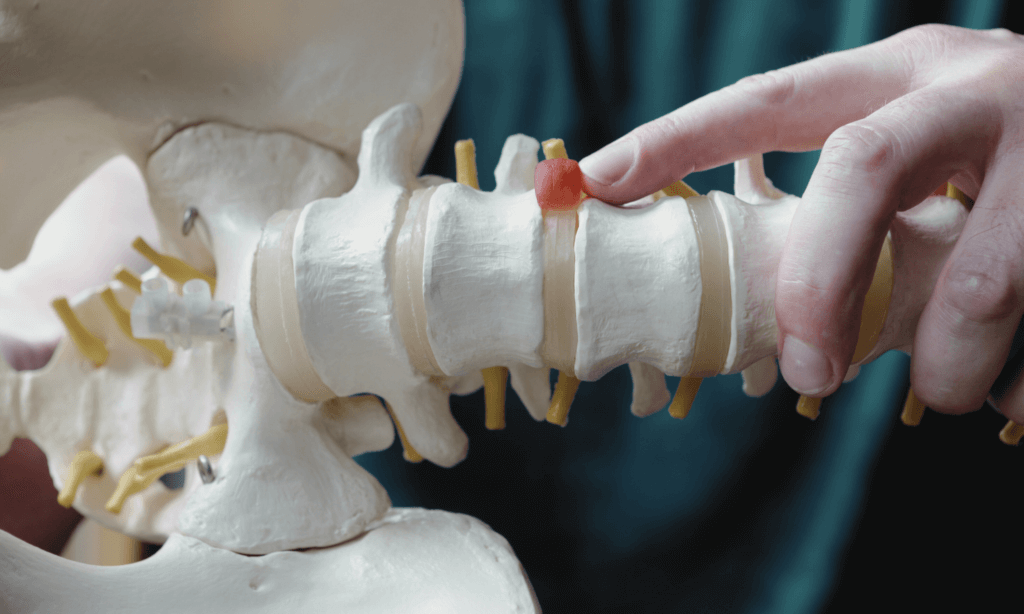 Межпозвоночная грыжа поясничного отдела. Протрузия крестцового отдела позвоночника. Позвоночник межпозвоночные диски. Грыжа протрузия позвоночника. Межпозвоночная грыжа позвоночника.